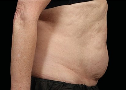 Abdômen depois do protocolo EMSCULPT NEO