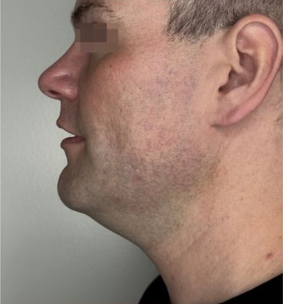 Perfil masculino com linha da mandíbula pouco definida antes do XERF